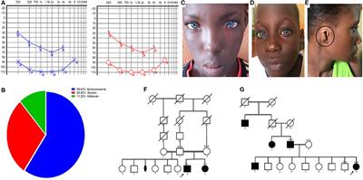 Etiologies of Childhood Hearing Impairment in Schools for the Deaf in Mali